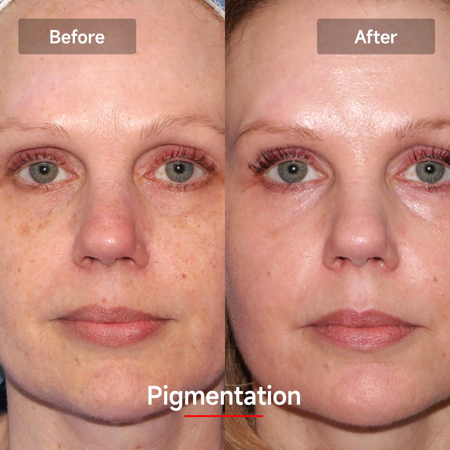Megelin LASER&LED Light Therapy Mask - Image 16
