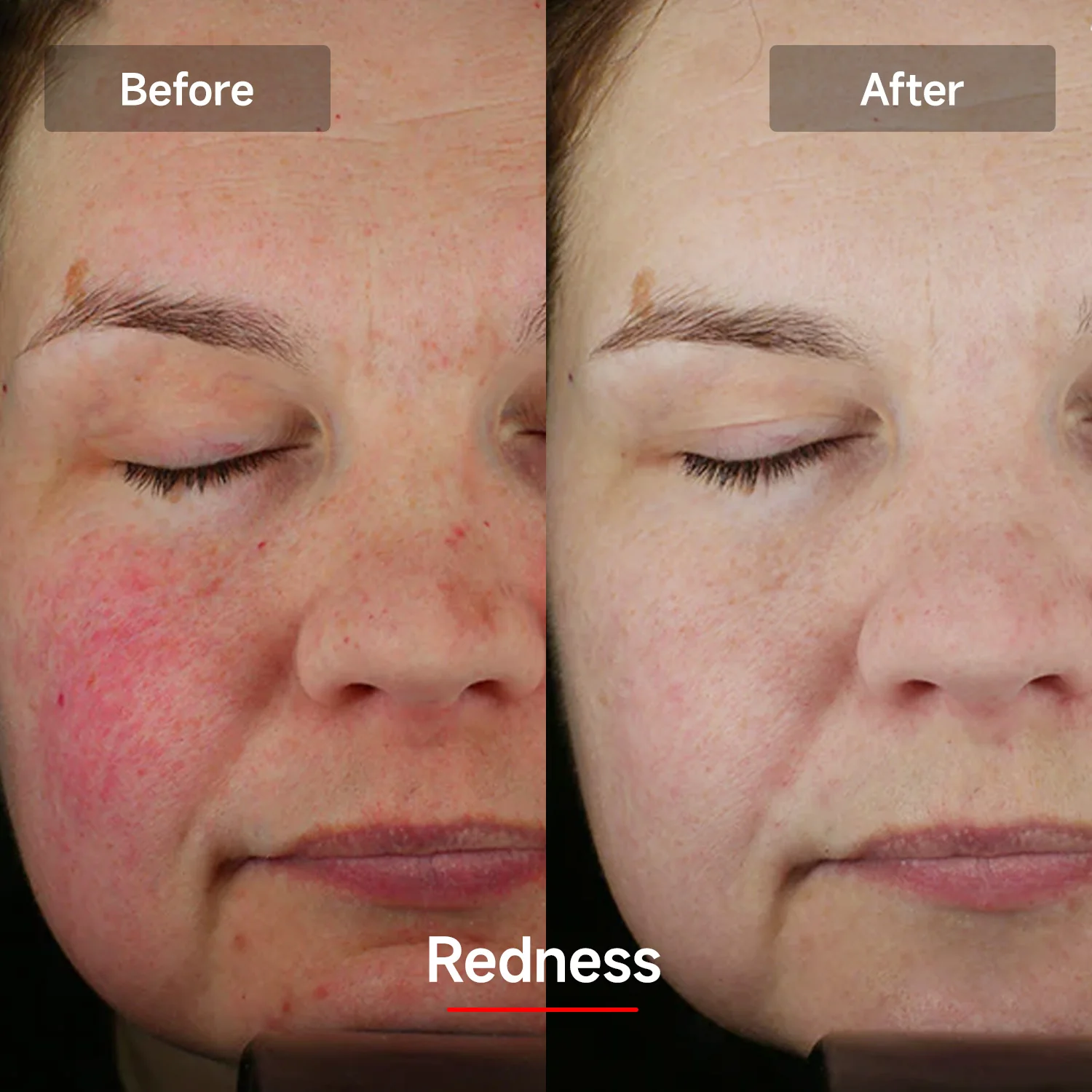 Megelin LASER&LED Light Therapy Mask - Image 17